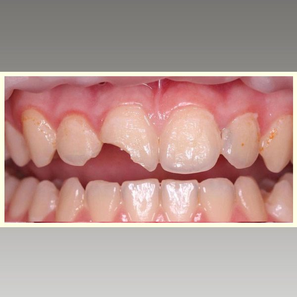 مركز د محمد عمارة لتجميل الاسنان Omara Dental Center حالات قبل وبعد 10