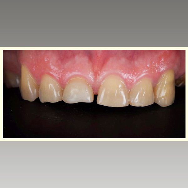 مركز د محمد عمارة لتجميل الاسنان Omara Dental Center حالات قبل وبعد 12