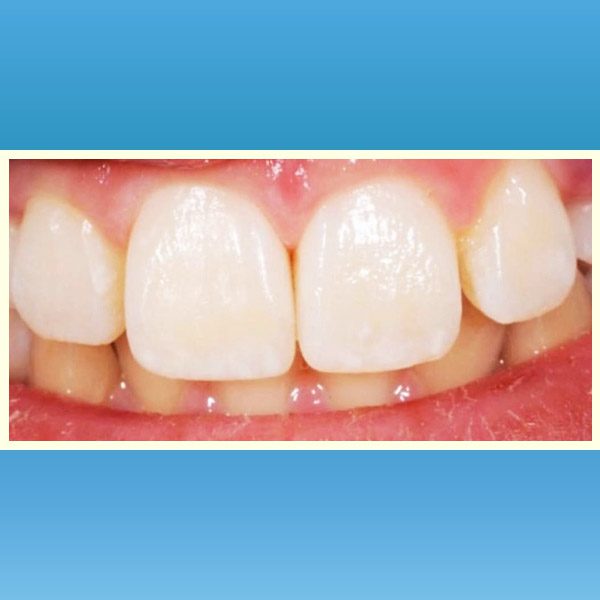 مركز د محمد عمارة لتجميل الاسنان Omara Dental Center حالات قبل وبعد 13