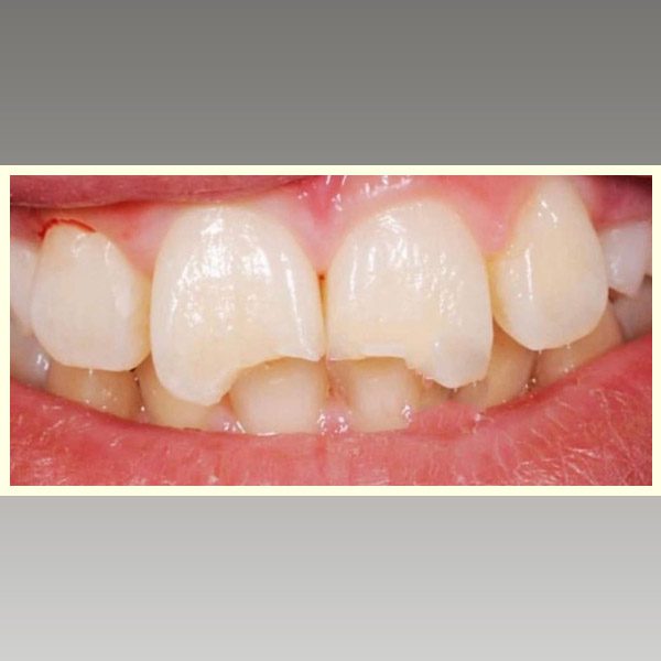 مركز د محمد عمارة لتجميل الاسنان Omara Dental Center حالات قبل وبعد 14