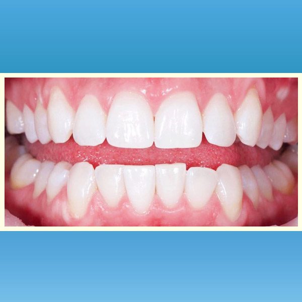 مركز د محمد عمارة لتجميل الاسنان Omara Dental Center حالات قبل وبعد 15