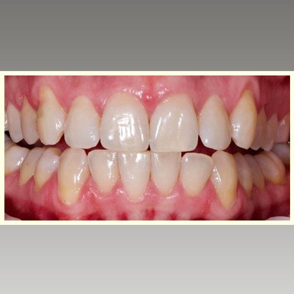 مركز د محمد عمارة لتجميل الاسنان Omara Dental Center حالات قبل وبعد 16