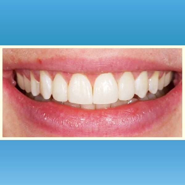 مركز د محمد عمارة لتجميل الاسنان Omara Dental Center حالات قبل وبعد 3