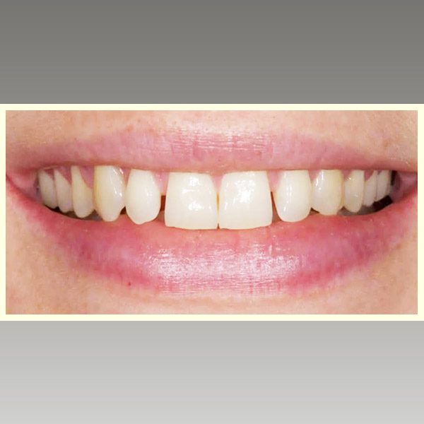 مركز د محمد عمارة لتجميل الاسنان Omara Dental Center حالات قبل وبعد 4