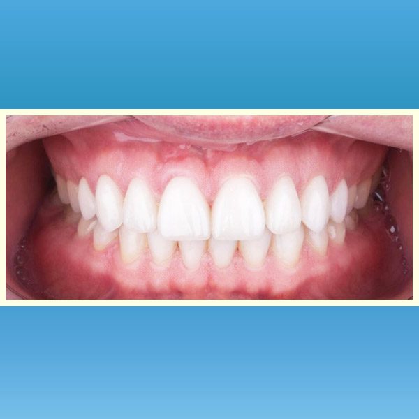 مركز د محمد عمارة لتجميل الاسنان Omara Dental Center حالات قبل وبعد 5