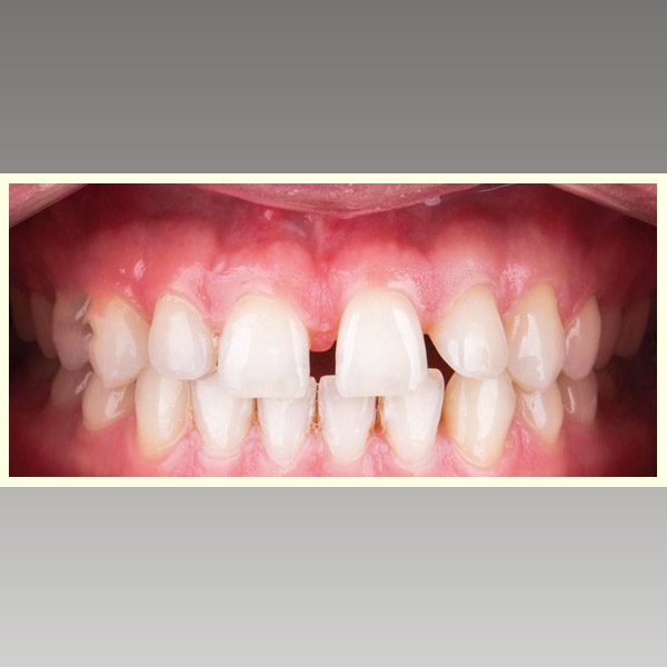 مركز د محمد عمارة لتجميل الاسنان Omara Dental Center حالات قبل وبعد 6