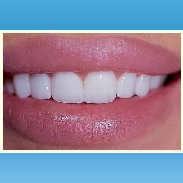 مركز د محمد عمارة لتجميل الاسنان Omara Dental Center حالات قبل وبعد 7