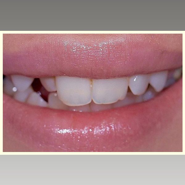 مركز د محمد عمارة لتجميل الاسنان Omara Dental Center حالات قبل وبعد 8