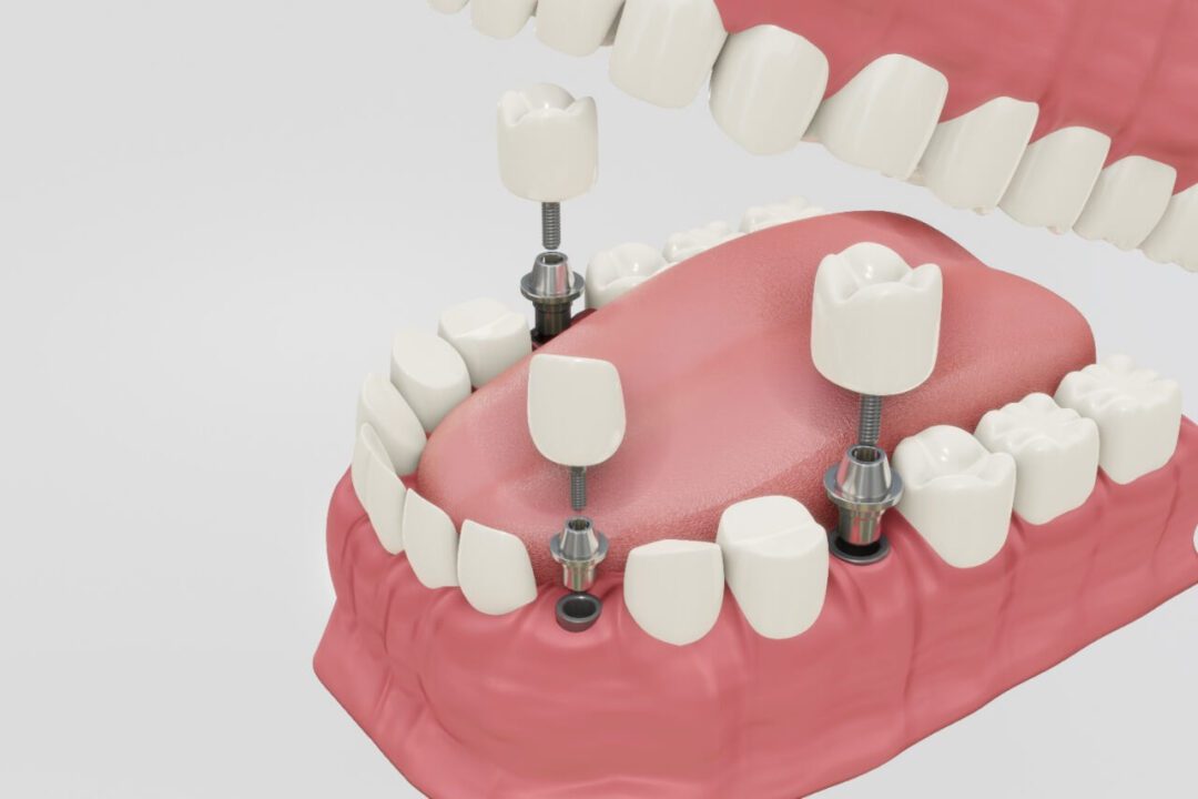 Impianti dentali in Egitto ,Dental Implants in Egypt , زراعة الأسنان فى مصر