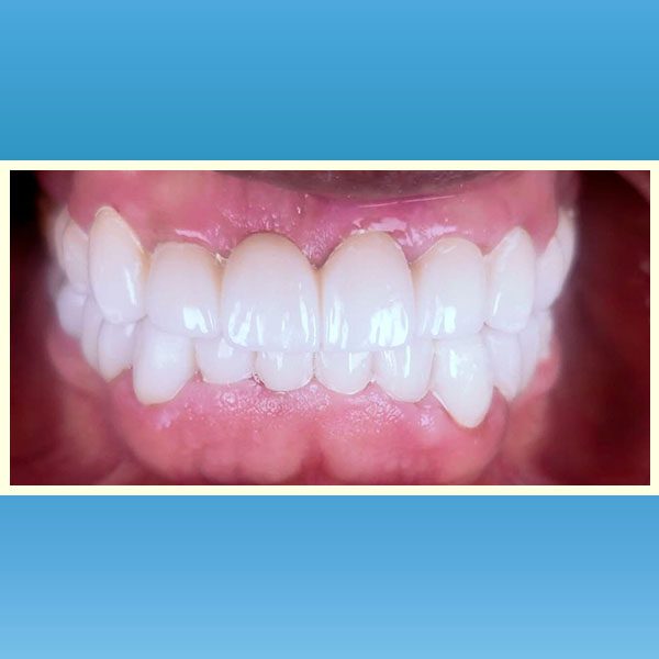 مركز د محمد عمارة لتجميل الاسنان Omara Dental Center حالات قبل وبعد 17