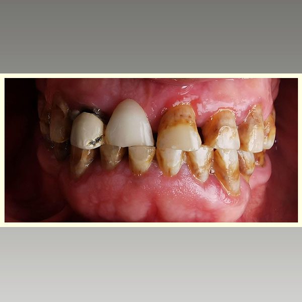 مركز د محمد عمارة لتجميل الاسنان Omara Dental Center حالات قبل وبعد 18