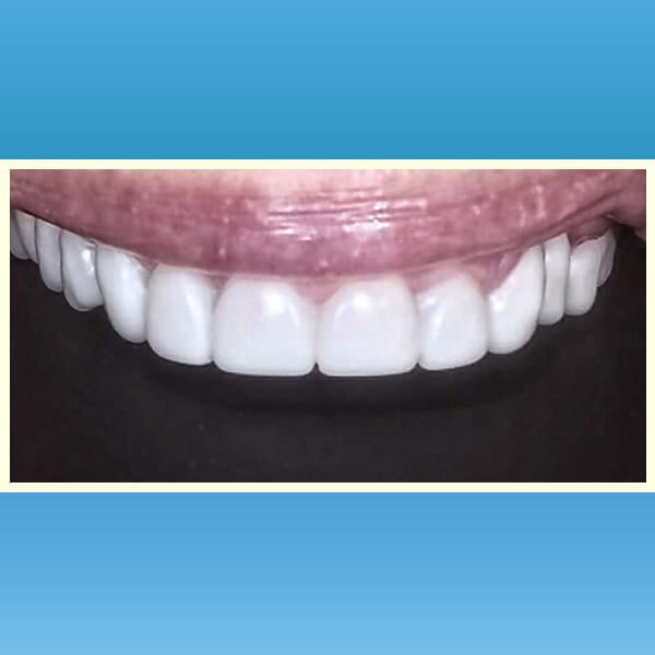 مركز د محمد عمارة لتجميل الاسنان Omara Dental Center حالات قبل وبعد 21