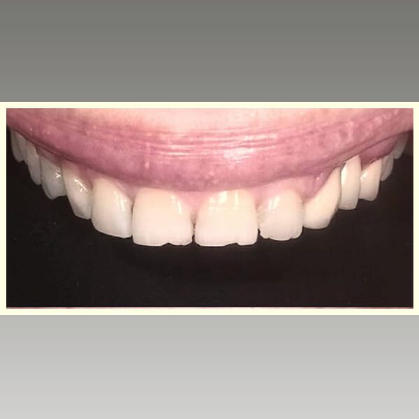 مركز د محمد عمارة لتجميل الاسنان Omara Dental Center حالات قبل وبعد 22