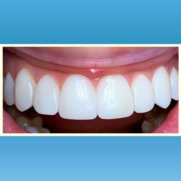 مركز د محمد عمارة لتجميل الاسنان Omara Dental Center حالات قبل وبعد 23