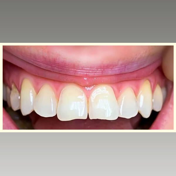 مركز د محمد عمارة لتجميل الاسنان Omara Dental Center حالات قبل وبعد 24