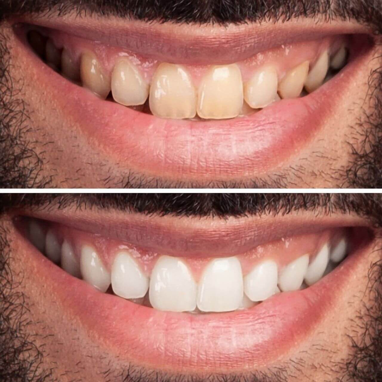 تبييض الاسنان بالليزر في مركز عمارة للأسنان Laser teeth whitening On Omara Dental Centers