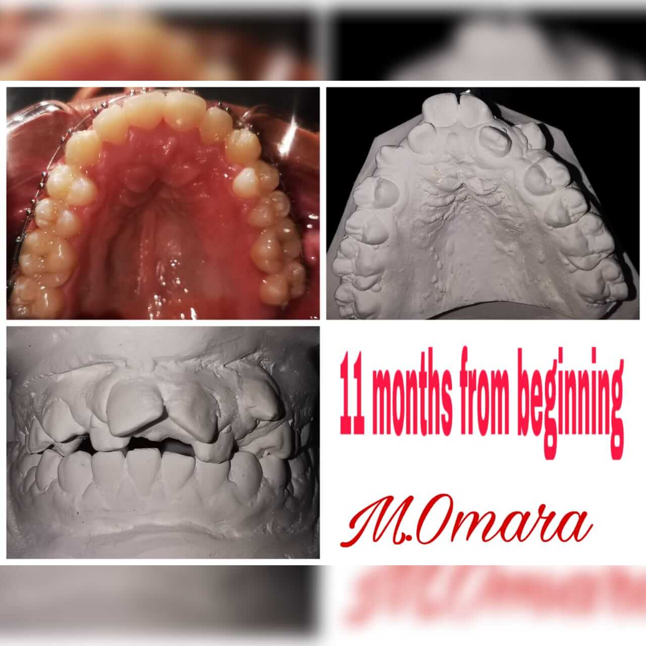 تقويم الأسنان مركز الدكتور محمد عمارة لطب الاسنانWhat is orthodontics Omara Dental Center