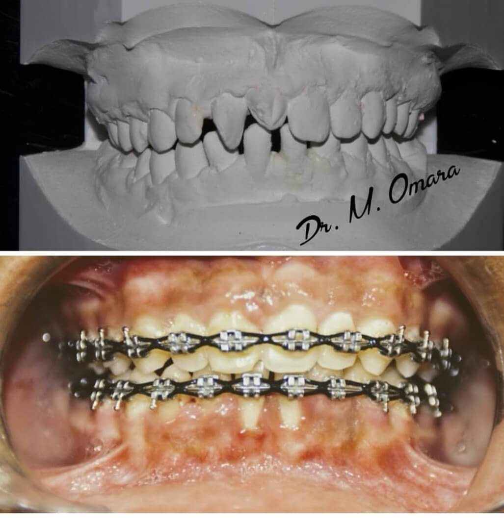 تقويم الأسنان مركز الدكتور محمد عمارة لطب الاسنانWhat is orthodontics Omara Dental Center