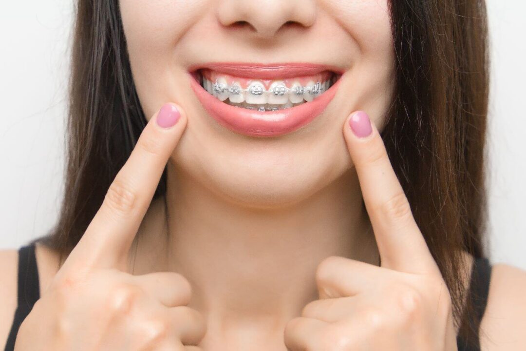 تقويم الأسنان مركز الدكتور محمد عمارة لطب الاسنانWhat is orthodontics Omara Dental Center