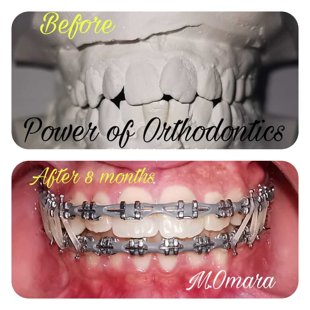 تقويم الأسنان مركز الدكتور محمد عمارة لطب الاسنانWhat is orthodontics Omara Dental Center