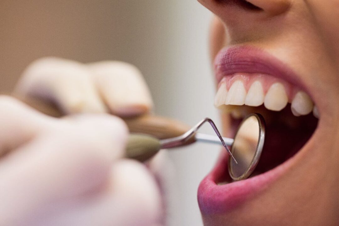 تنظيف الأسنان من الجير في مركز عمارة للأسنان دكتورة صفاء الليثي