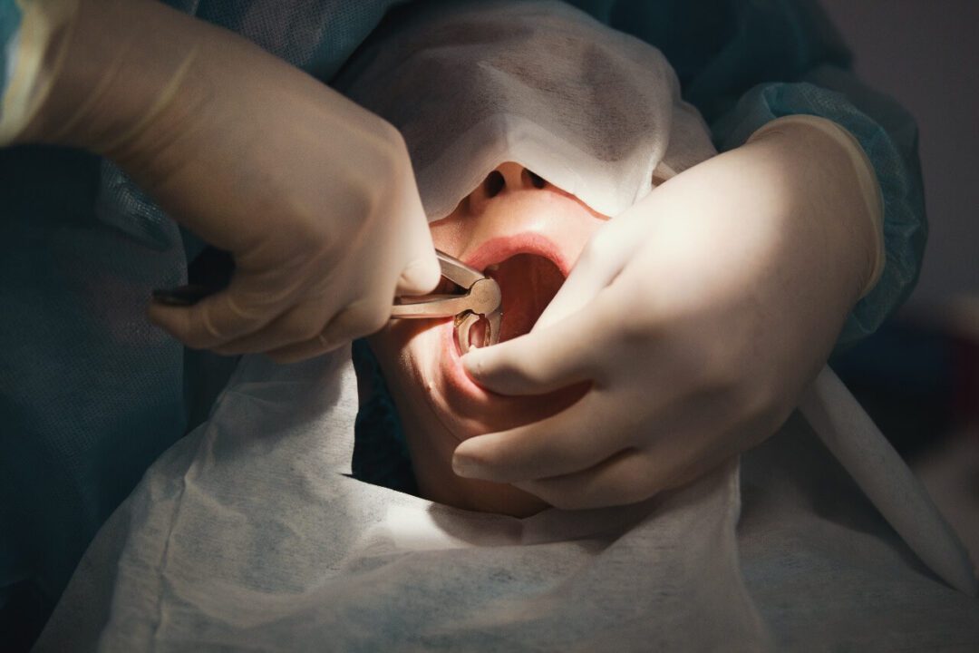 خلع ام حشوات الاسنان مركز الدكتور عمارة لطب الاسنان Tooth Extraction or Fillings Omara Dental Centers