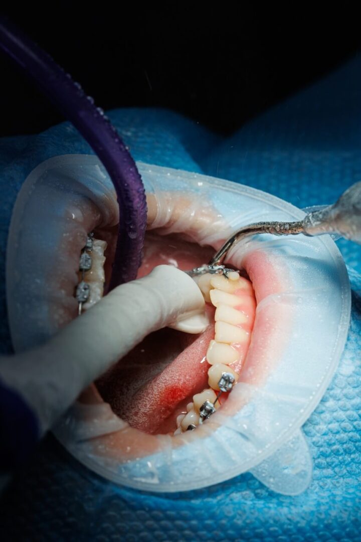 خلع ام حشوات الاسنان مركز الدكتور عمارة لطب الاسنان Tooth Extraction or Fillings Omara Dental Centers
