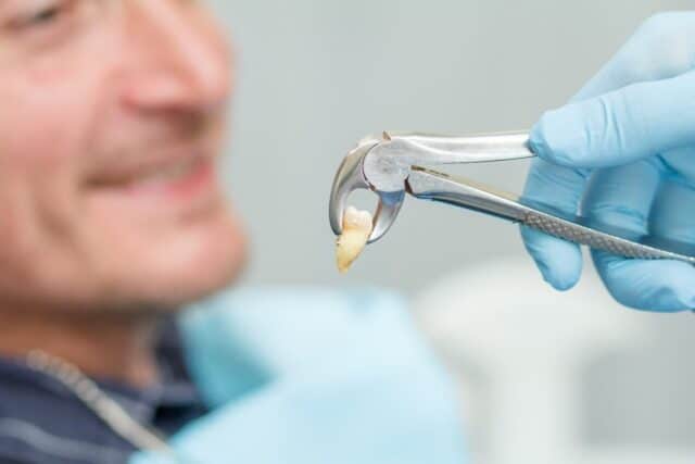 خلع الأسنان مركز الدكتور عمارة لطب الاسنان Tooth extraction Omara Dental Centers