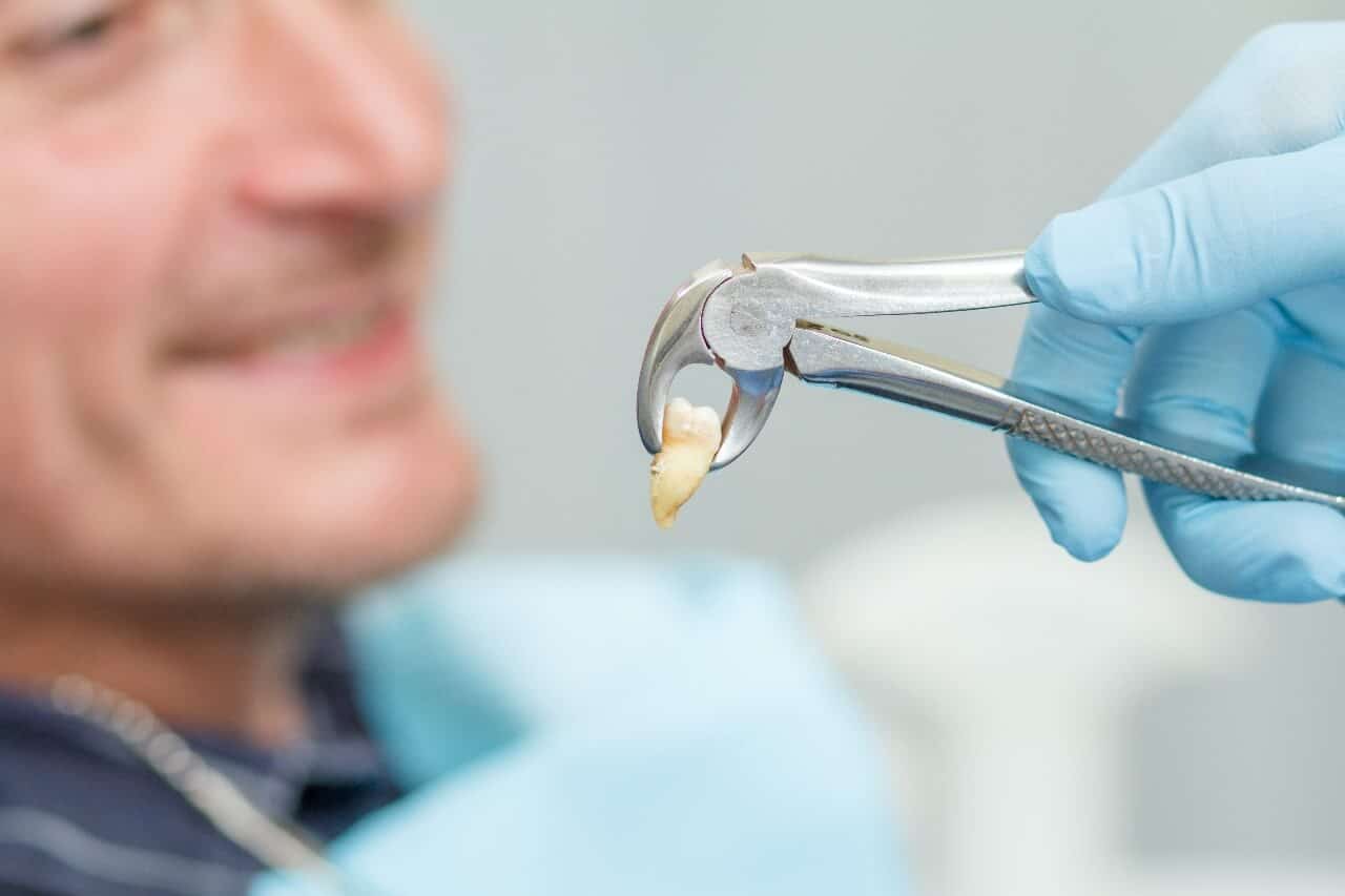 خلع الأسنان مركز الدكتور عمارة لطب الاسنان Tooth extraction Omara Dental Centers