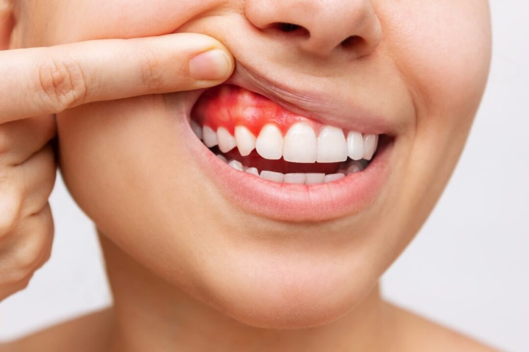 علاج أمراض اللثة للأسنان مركز الدكتور محمد عمارة لطب الاسنان Periodontitis (Gum Disease) Periodontal Disease Omara Dental Centers , Malattie gengivali , Omara centri odontoiatrici , Maladies des Gencives