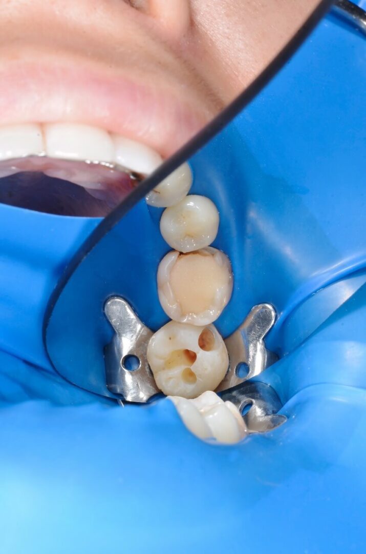 علاج جذور الأسنان مركز الدكتور محمد عمارة لطب الاسنان root canal treatment Omara dental center 18