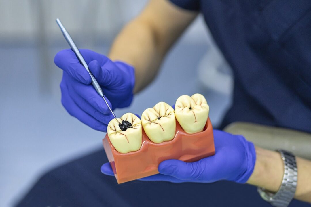 علاج جذور الأسنان مركز الدكتور محمد عمارة لطب الاسنان root canal treatment Omara dental center 5