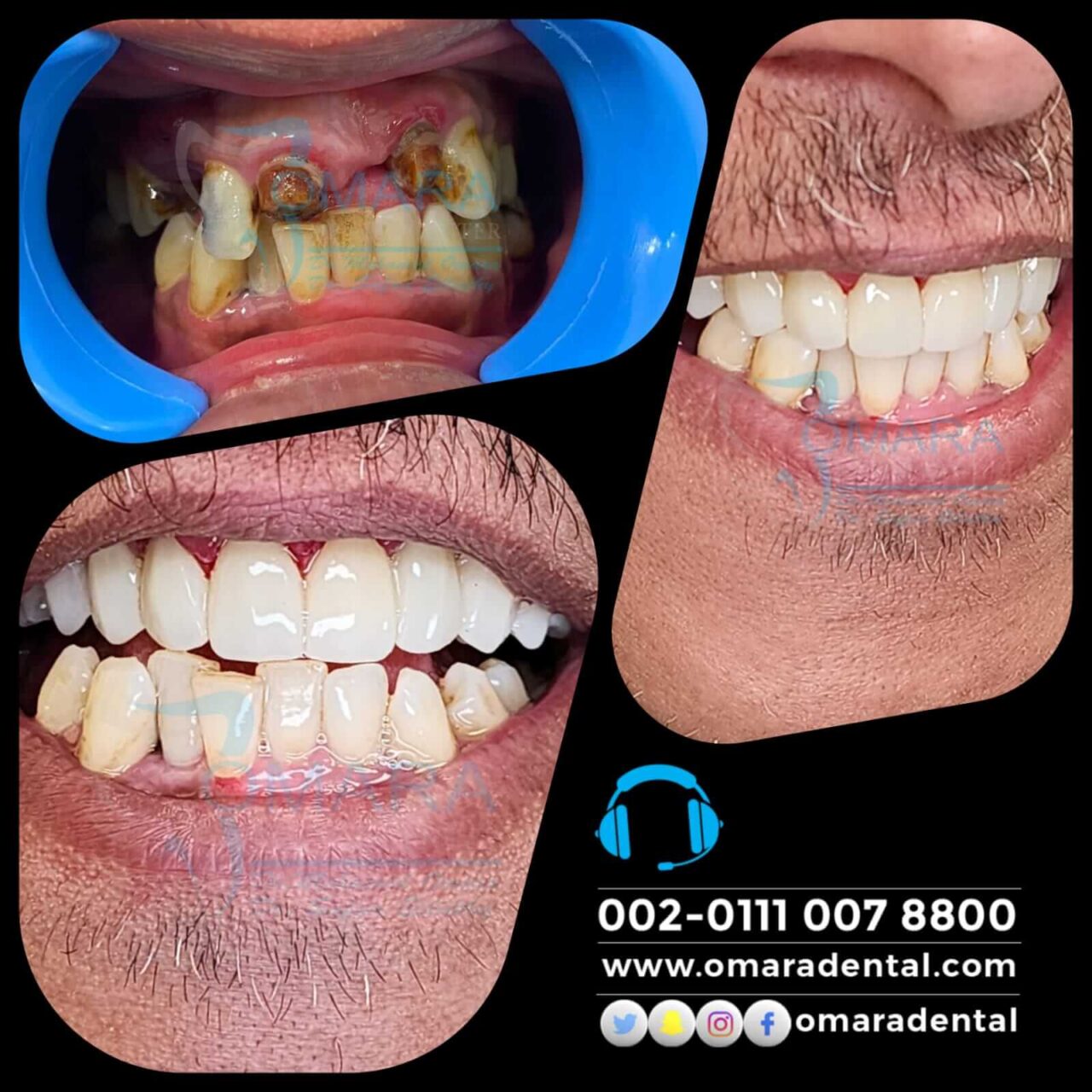 حالات تم علاجها فى مراكز الدكتور محمد عمارة لطب الاسنان Some cases of Omara dental centers , Alcuni casi