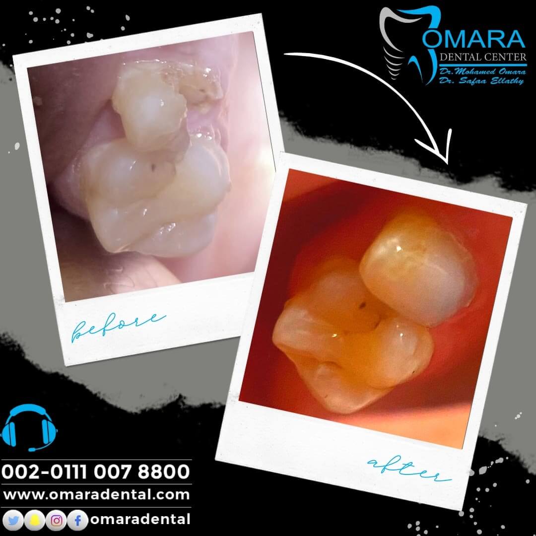 حالات تم علاجها فى مراكز الدكتور محمد عمارة لطب الاسنان Some cases of Omara dental centers , Alcuni casi