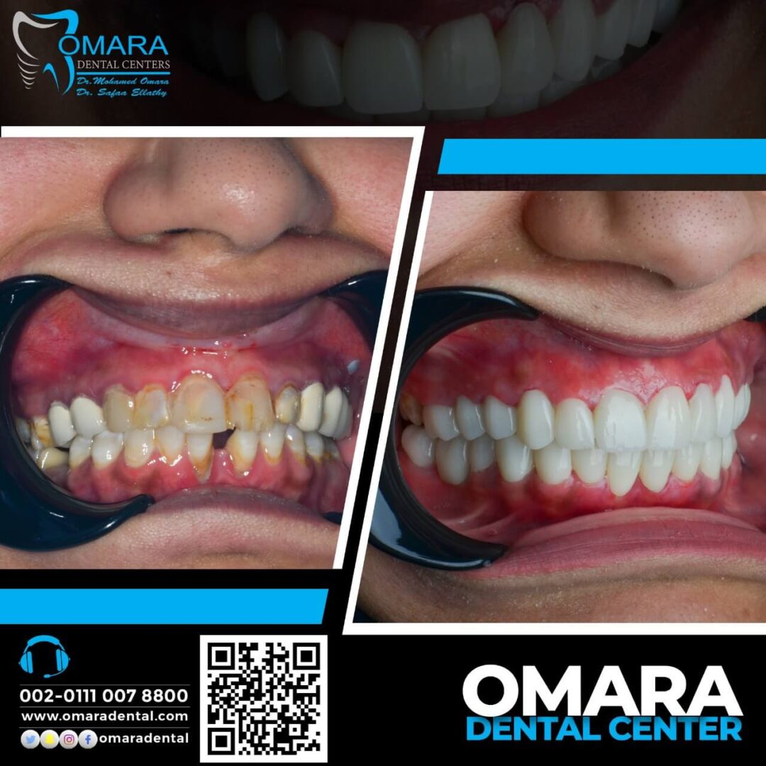 حالات تم علاجها فى مراكز الدكتور محمد عمارة لطب الاسنان Some cases of Omara dental centers , Alcuni casi