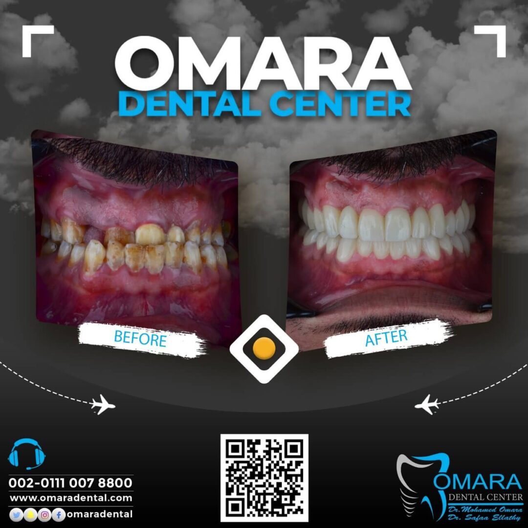 حالات تم علاجها فى مراكز الدكتور محمد عمارة لطب الاسنان Some cases of Omara dental centers , Alcuni casi