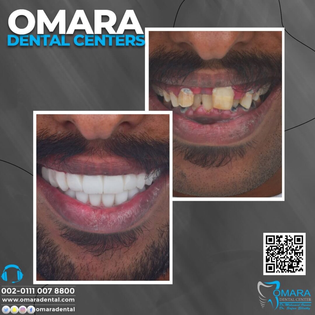 حالات تم علاجها فى مراكز الدكتور محمد عمارة لطب الاسنان Some cases of Omara dental centers , Alcuni casi