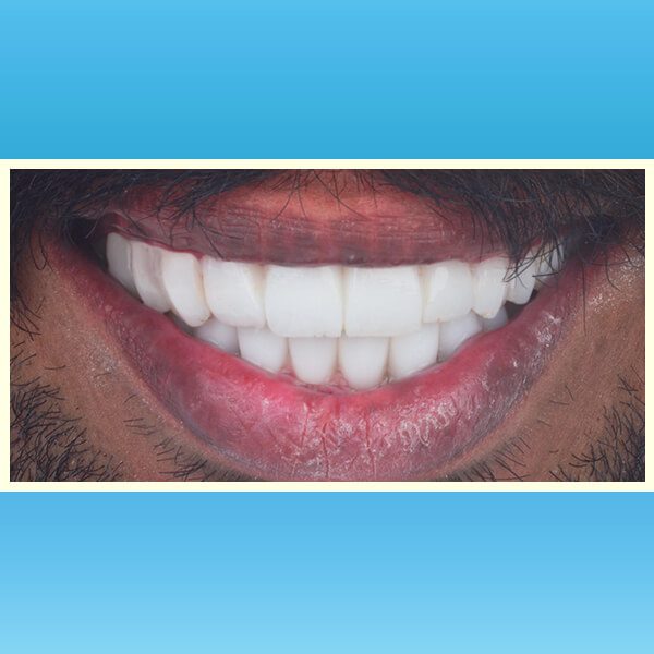 مركز د محمد عمارة لتجميل الاسنان Omara Dental Center حالات قبل وبعد 23