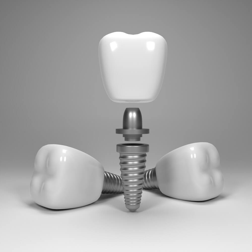 Dental Implants Impianti dentali in Egitto زراعة الأسنان تجميل اليوم الواحد تجميل الأسنان الفوري مراكز الدكتور محمد عمارة لطب الاسنان 5