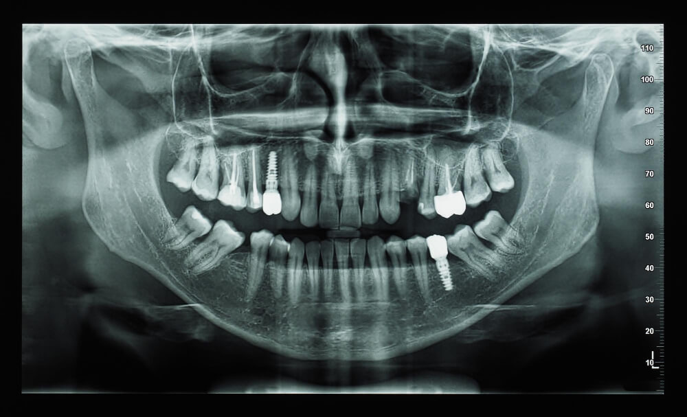 Dental Implants Impianti dentali in Egitto زراعة الأسنان تجميل اليوم الواحد تجميل الأسنان الفوري مراكز الدكتور محمد عمارة لطب الاسنان