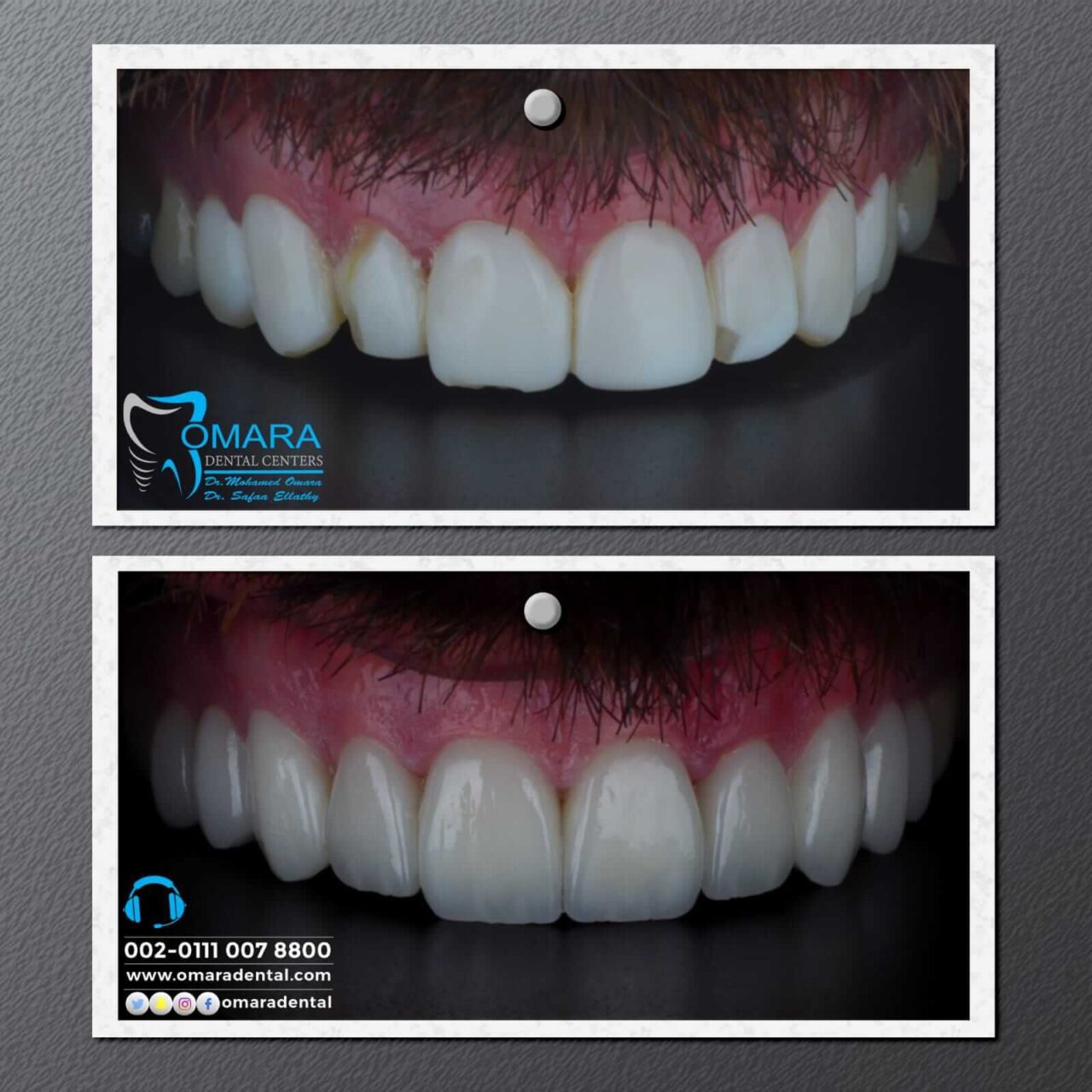 حالات تم علاجها فى مراكز الدكتور محمد عمارة لطب الاسنان Some cases of Omara dental centers , Alcuni casi (4)