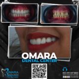 حالات تم علاجها فى مراكز الدكتور محمد عمارة لطب الاسنان Some cases of Omara dental centers Alcuni casi 8 -