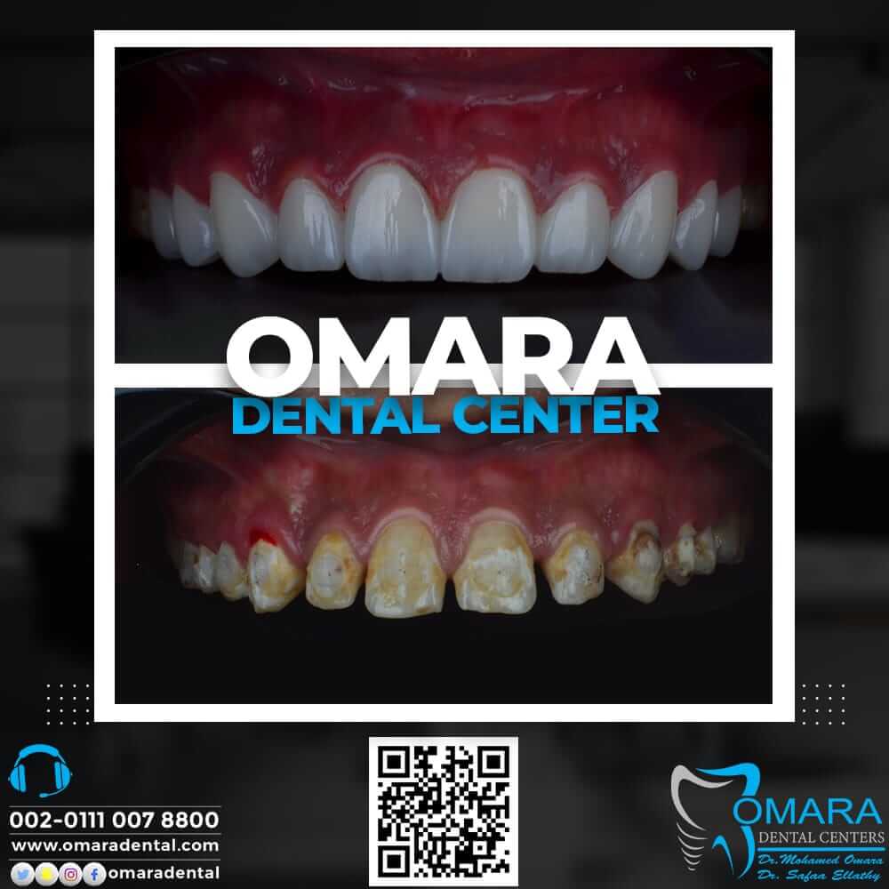حالات تم علاجها اسنان قبل وبعد فى مراكز الدكتور محمد عمارة لطب الاسنان Some cases of Omara dental centers , Alcuni casi (11)