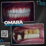 حالات تم علاجها اسنان قبل وبعد فى مراكز الدكتور محمد عمارة لطب الاسنان Some cases of Omara dental centers Alcuni casi 12 -