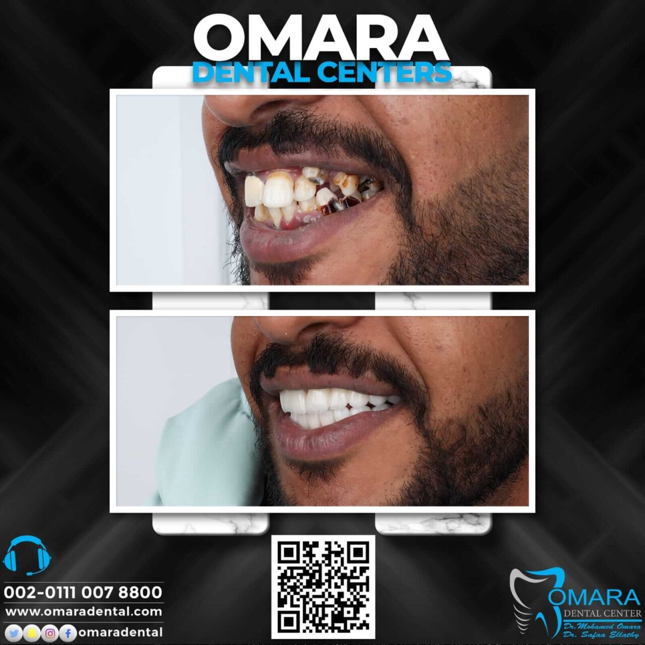 حالات تم علاجها اسنان قبل وبعد فى مراكز الدكتور محمد عمارة لطب الاسنان Some cases of Omara dental centers , Alcuni casi (14)