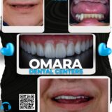 حالات تم علاجها اسنان قبل وبعد فى مراكز الدكتور محمد عمارة لطب الاسنان Some cases of Omara dental centers Alcuni casi 19 -