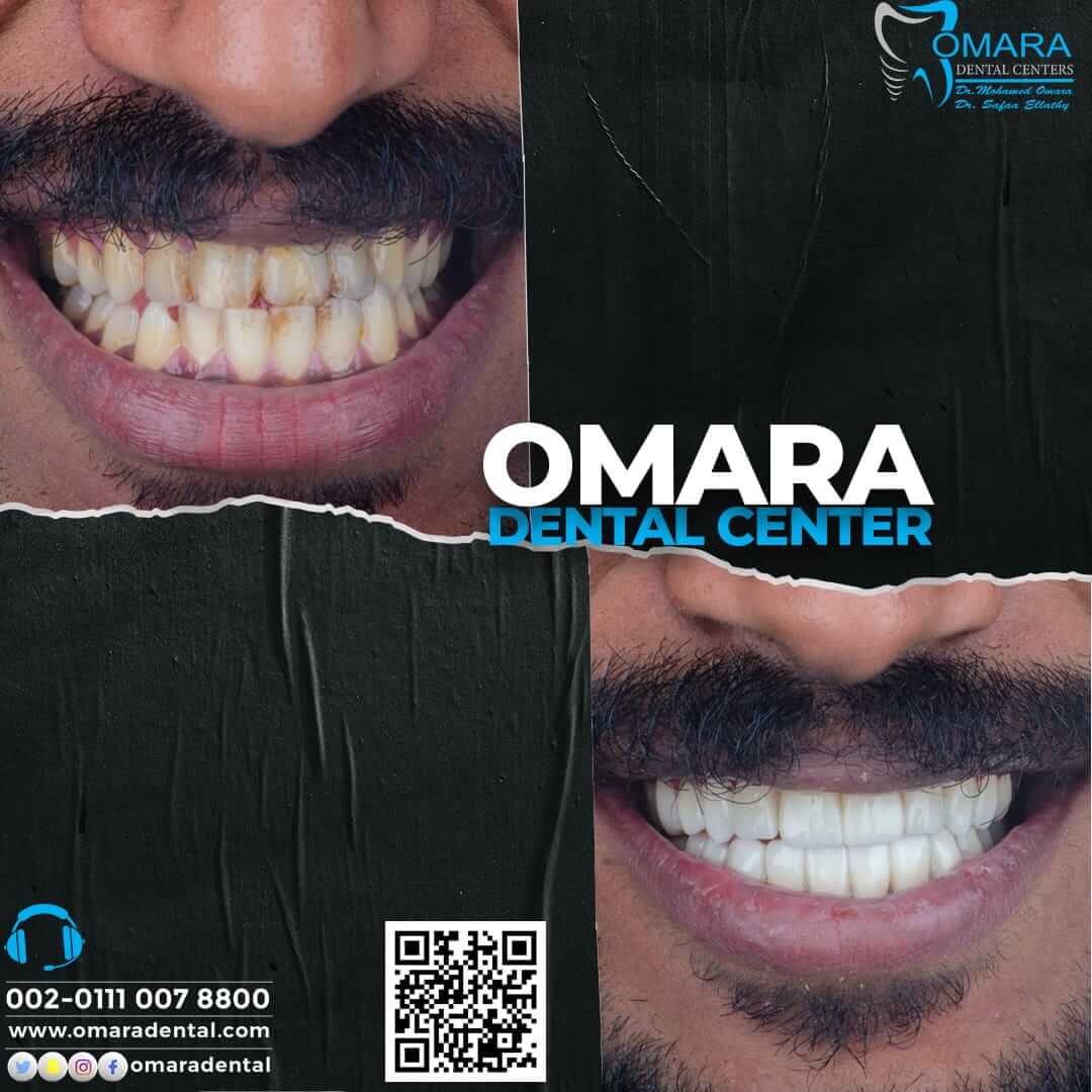 حالات تم علاجها اسنان قبل وبعد فى مراكز الدكتور محمد عمارة لطب الاسنان Some cases of Omara dental centers , Alcuni casi 2