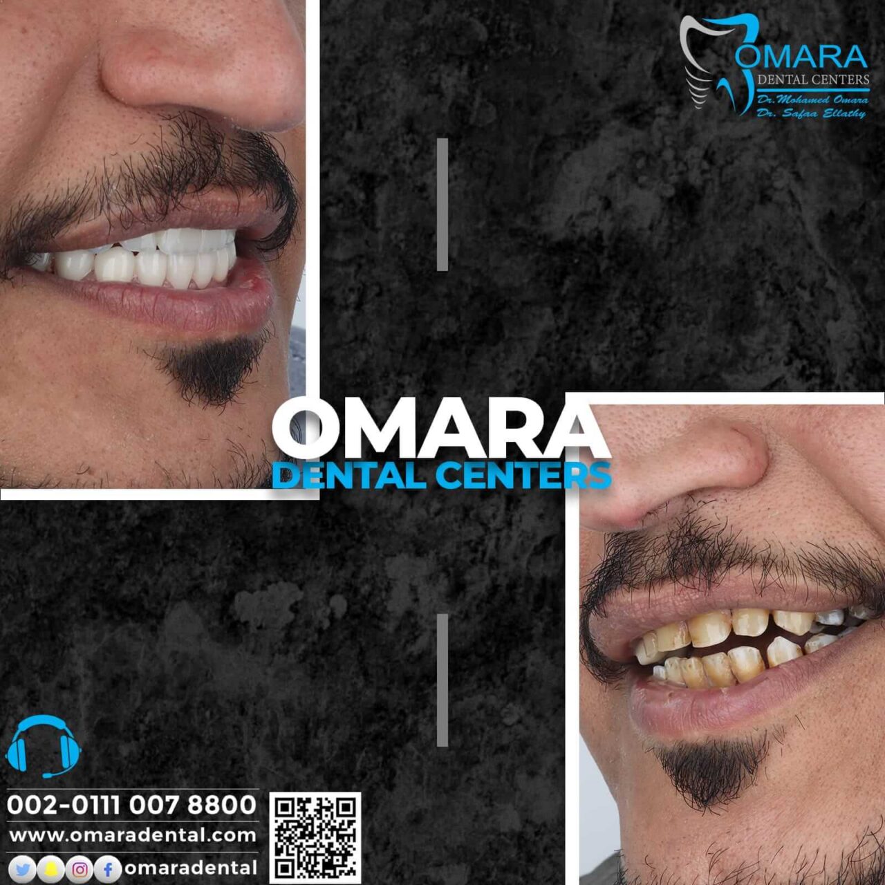 حالات تم علاجها اسنان قبل وبعد فى مراكز الدكتور محمد عمارة لطب الاسنان Some cases of Omara dental centers , Alcuni casi (23)