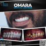 حالات تم علاجها اسنان قبل وبعد فى مراكز الدكتور محمد عمارة لطب الاسنان Some cases of Omara dental centers Alcuni casi 28 -