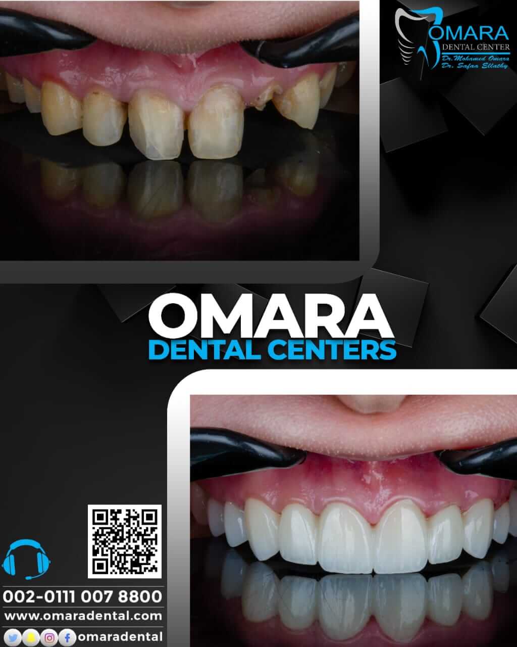 حالات تم علاجها اسنان قبل وبعد فى مراكز الدكتور محمد عمارة لطب الاسنان Some cases of Omara dental centers , Alcuni casi (31)
